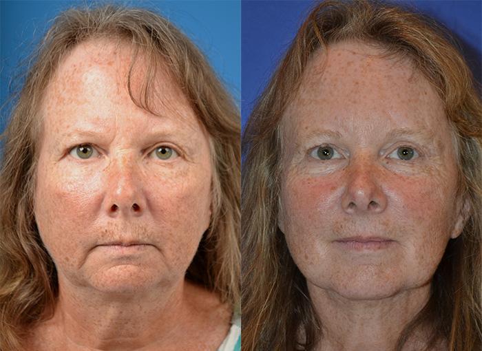 Laser Assisted Weekend Neck Lift Photos Melbourne, FL Patient 28561